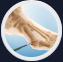 Bunion Surgery